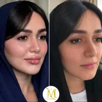 ژل640 بوتاکس690 فول فیس4500 افر %80