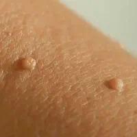 حذف خال های گوشتی