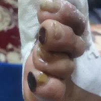 مراقب از انواع زخم توسط کارشناس زخم