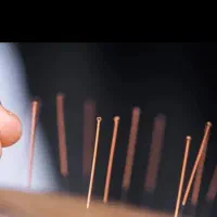 طب سنتی ،سوزنی