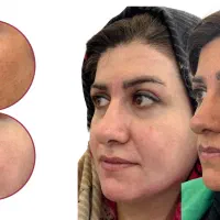 لیزر co2 ، لیزر ترکیبی تک جلسه ای ، لیزر لک