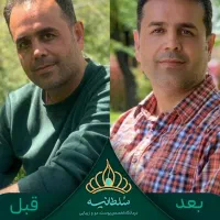 کاشت مو حتی با بانک مو ضعیف