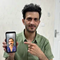 کاشت مو و ابرو حرفه ای