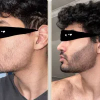 پرپشتی ریش و سبیل