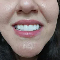 ایمپلنت دندان