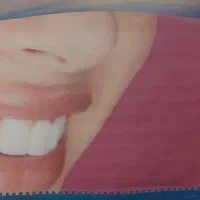 دندانسازی تجربی در سرتوهن گلن