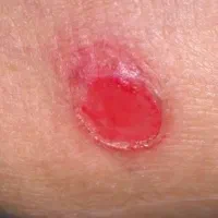 معجزه بهبود زخم بستر ،دیابتی و سایر زخم ها