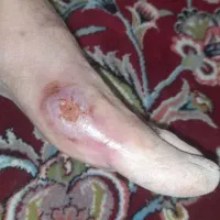 ترمیم تخصصی زخم