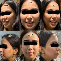 ژل نخ لیفت مزوژل(توسط پزشک)۲۰ درصد تخفیف