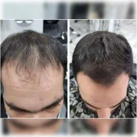 روش جدید و علمی فرانسه رویش و پرپشتی مو