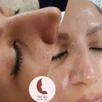 فیشال تخصصی و پاکسازی عمیق پوست صورت
