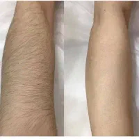 جواب تضمینی لیزر موهای زائد