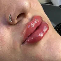 ژل و بوتاکس