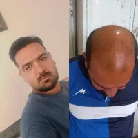 کاشت مو، ابرو وریش یا ضمانت نامه
