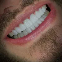 ایمپلنت کره‌ای و آلمانی ،روکش رایگان 15/500+اقساط