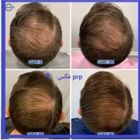 جوان‌سازی و تقویت مو با PRP + مزونیدلینگ