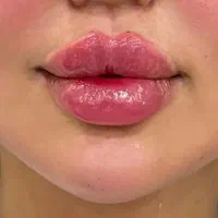 تزریق ژل لب ،فیلر بوتاکس ،پیرسینگ گوش بینی ناف