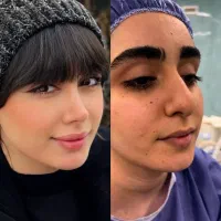 جراحی زیبایی بینی دولتی + اقساطی