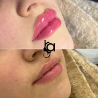 نیازمند مدل جهت تزریق زیبایی توسط پزشک