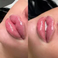 جشنواره ۵۰٪تخفیف بوتاکس،فیلر لب روسی،و زاویه‌سازی