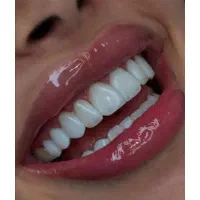 خدمات تخصصی پالیش دندان