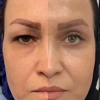 کرم۱۵کاربیوممتیک ضدچروک ودورچشم ودرمان افتادگی پلک