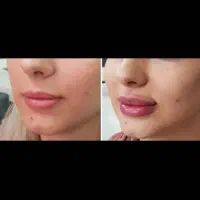 بوتاکس ژل فیلر مزوتراپی لیزر هایفو لیفت نخ در مطب