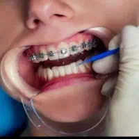 ارتودنسی اطفال و بزرگسال با شرایط تمام اقساط