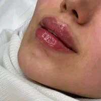 بوتاکس مصپورت فقط۴۹۰ کلینیک زیبایی دکتر فرشیدکریمی