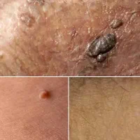 رفع قطعی و دائمی زگیل و تبخال تناسلی