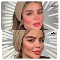 کاشت ابرو با متد میکروکاشت