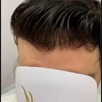 پروتز مو ماکروپوینت (کاشت موقت)