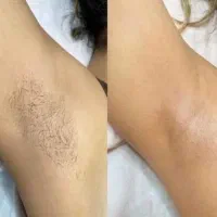 لیزر موهای زائد بانوان کلینیک صدف تخفیف داره