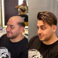 پروتز مو وارداتی ،کاشت hrt