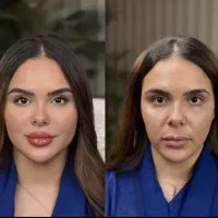 بوتاکس مصپورت ۹۹۰ ۵۰ ٪ تخفیف فیلر فول فیس ،زیر چشم