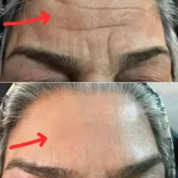 بوتاکس را فراموش کن