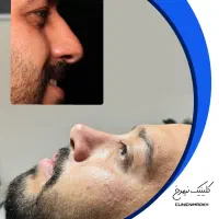 ۵۰% تخفیف برای عمل بینی