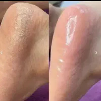 اسپا،ترمیم،ژلیش