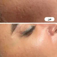 فیشیال تخصصی رفع لک ،جوش ،خشکی ، پاکسازی پوست