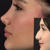 رینوپلاستی /مامو/لیپو/پروتز در تهران