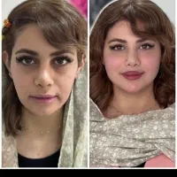جشنواره تخفیف فیلر و بوتاکس