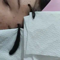 حجامت، فصد خون، زالو درمانی در منزل