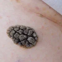 رفع اصولی زگیل تناسلی HPV