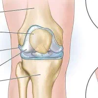 بهبودی رگگیری و انجام حجامت و فصد ط سنتی و هندی