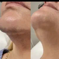 لیزر مو های زائد نتیجه عالی بدون تماس مستقیم