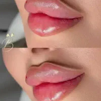 آف ویژه ژل و بوتاکس و مزو