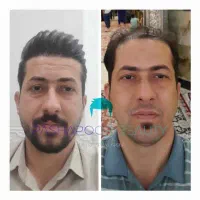 کاشت مو