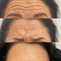 بوتاکس  پیشانی و زیر بغل تخفیف ویژه