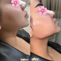 تزریق فیلر،ژل لب، آنزیم،بوتاکس