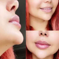 تزریق ژل و بوتاکس